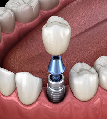 Illustration of a dental implant and crown replacing a missing lower tooth