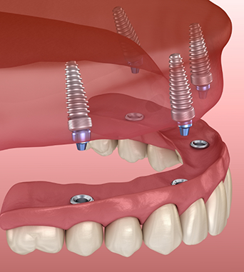 Illustration of a denture being secured onto four dental implants along the upper arch