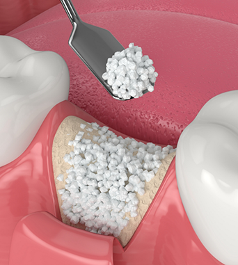 Illustration of bone grafting material being placed in the jawbone after a tooth extraction