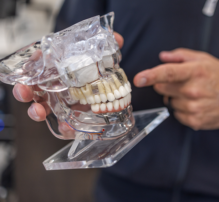 Oral surgeon holding a model of the mouth with dental implants