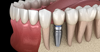 Illustration of a dental implant in the lower jawbone