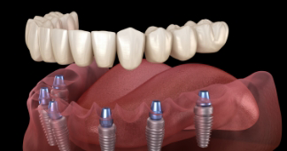 Illustration of a full denture being secured onto six dental implants