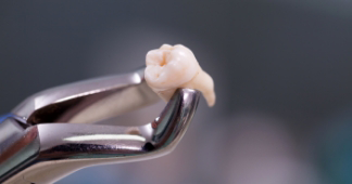 Forceps holding an extracted tooth