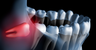 Illustration of an impacted wisdom tooth pressing against the adjacent tooth