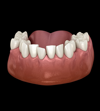 Illustration of a lower arch of crowded teeth