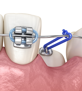 Illustration of a partially erupted tooth with a bracket and chain connecting it to the adjacent teeth with braces