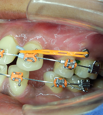 Close up of a mouth with braces and a screw in the upper jawbone attached to an elastic band