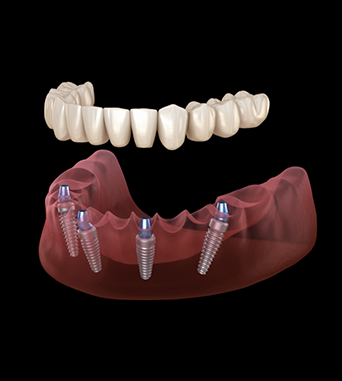 Illustration of a Teeth in a Day denture being secured onto four dental implants