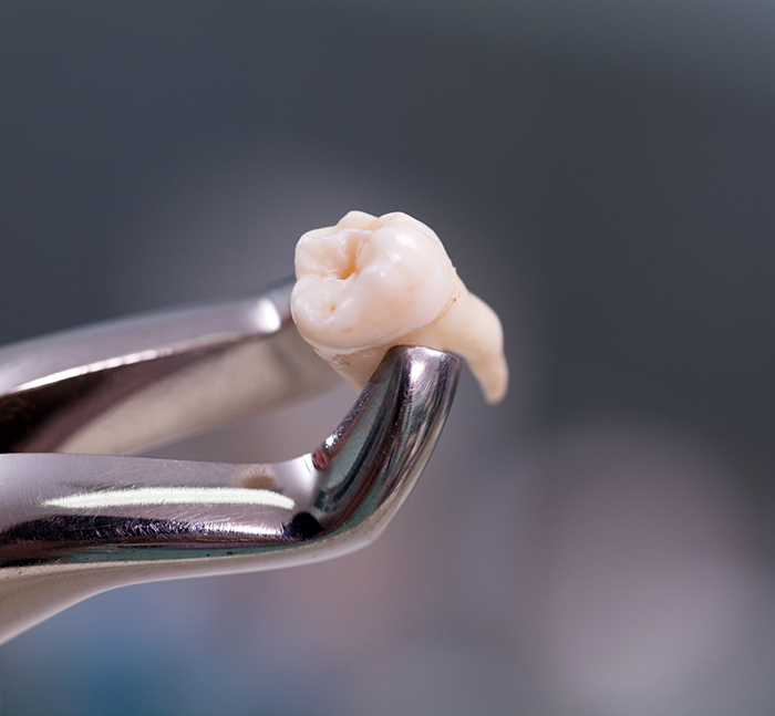 Forceps holding an extracted tooth