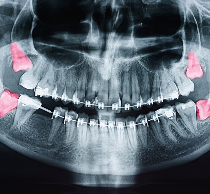 Dental X ray with the wisdom teeth highlighted red