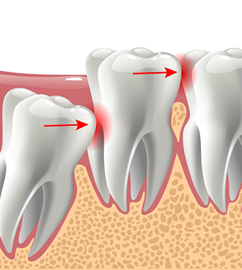 Illustration of an impacted wisdom tooth pressing against the adjacent tooth